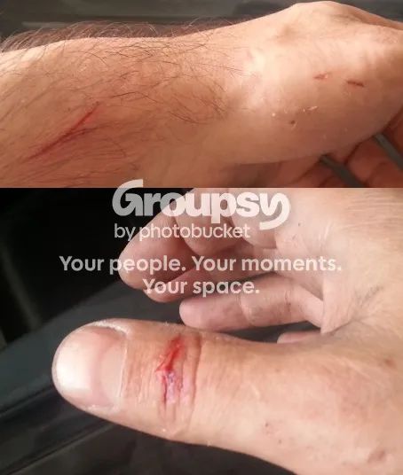 Cuts and scratches on a forearm and thumb